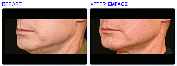 EMFACE before and after
