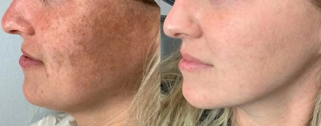 IPL Before & After